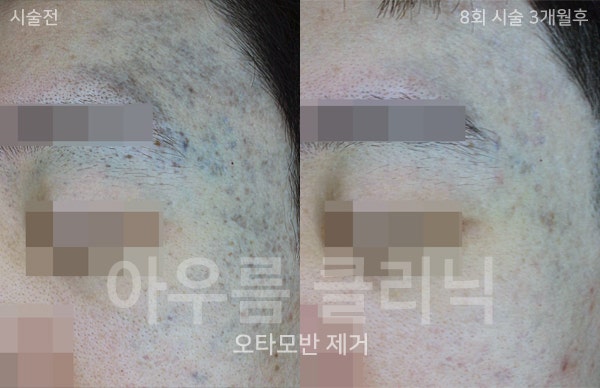 회복 경과