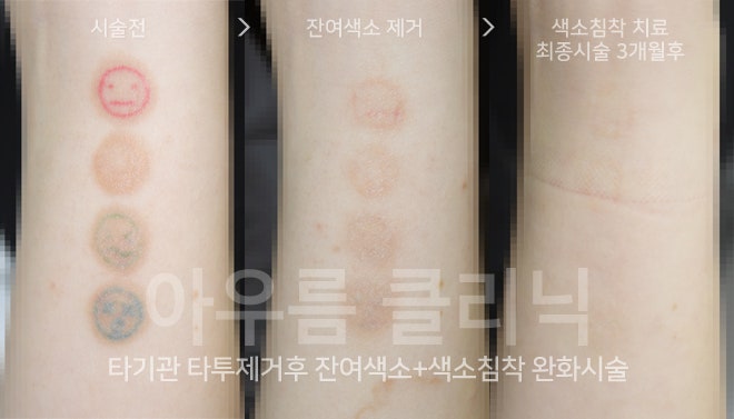 색소 분포