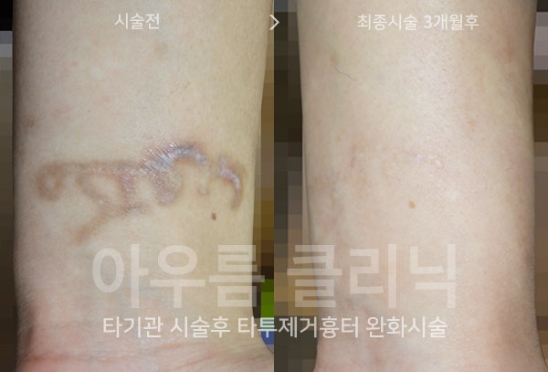 문신제거잘하는곳을 가늠할 때 살펴보는 회차 계획과 간격 설계 - 아우름의원