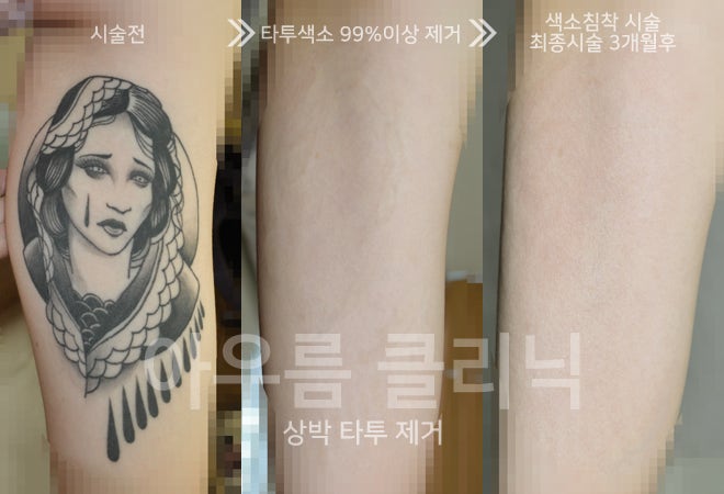 색소반응