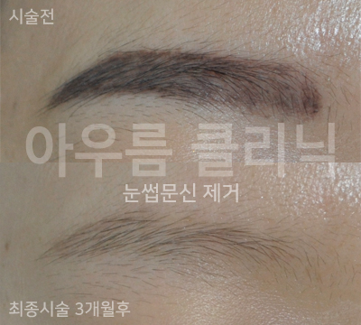 반영구화장 제거가 일반 문신 제거와 다른 이유, 안료와 색 변화 — 아우름의원