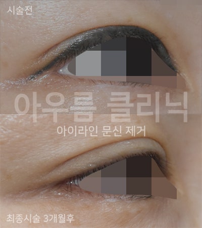 색소 분포