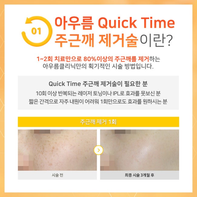 레이저 조사