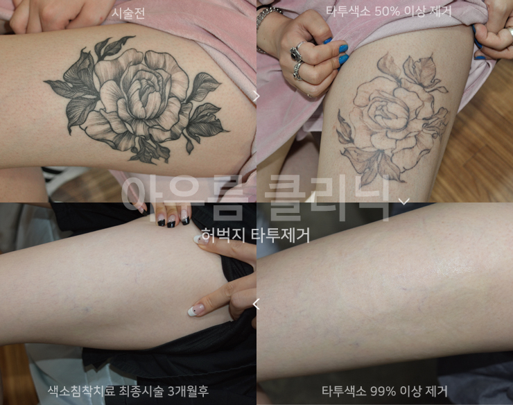 강남역피코레이저 시술 후 자외선 차단제 고르는 기준 — 아우름의원
