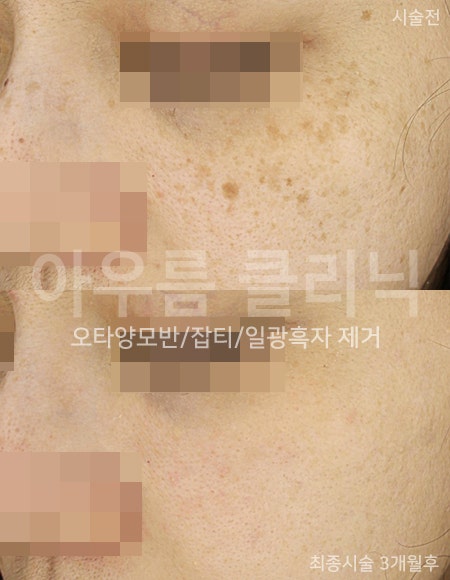 증상비교