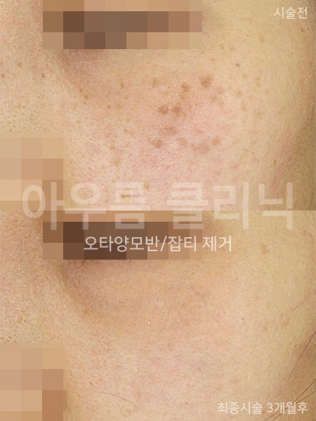 진단기준