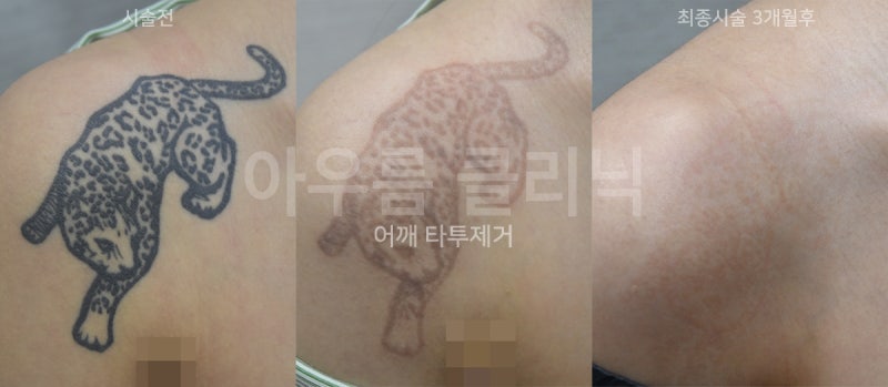 타투제거비용 계획을 조정하게 되는 회차별 경과 관찰 방법 — 아우름의원