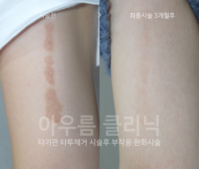 보호막형성