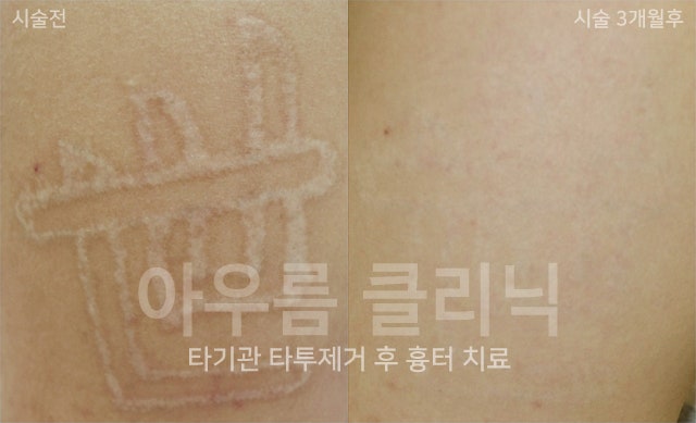 색소 분포