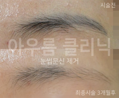 흉터관리
