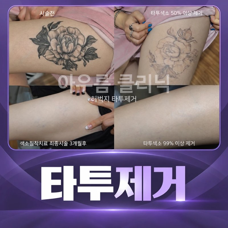 타투제거