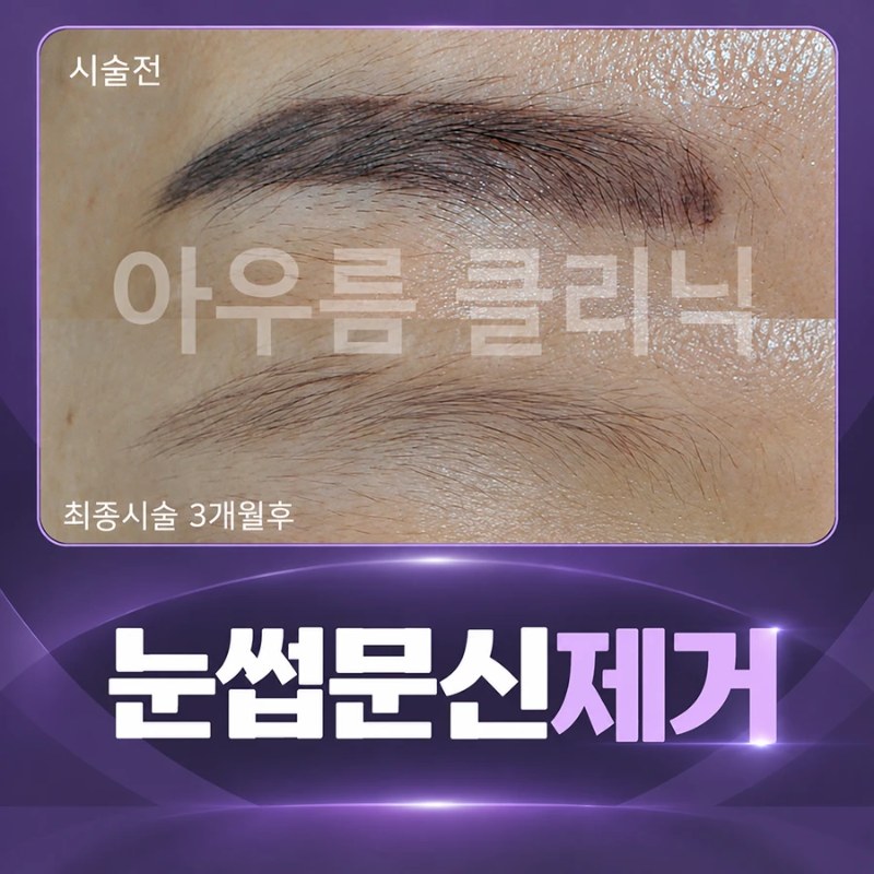 눈썹문신제거